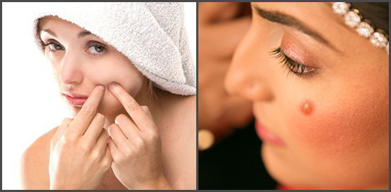 Bride's pimple.weddingplz