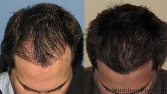 Hair Transplant Cost in Dubai UAE  Cost of Hair Transplant Dubai